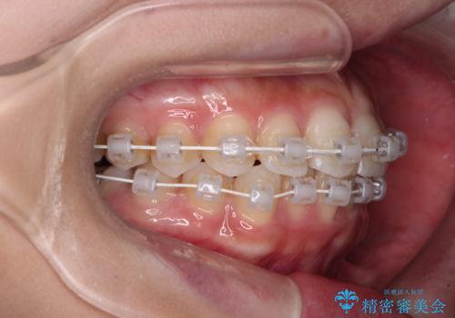 歯をきれいにしたい　ワイヤー矯正治療と虫歯治療の治療中