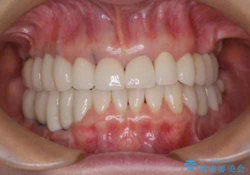 以前治療した歯がボロボロに　全顎補綴治療の症例 治療後