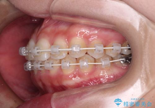 歯をきれいにしたい ワイヤー矯正治療と虫歯治療の治療中