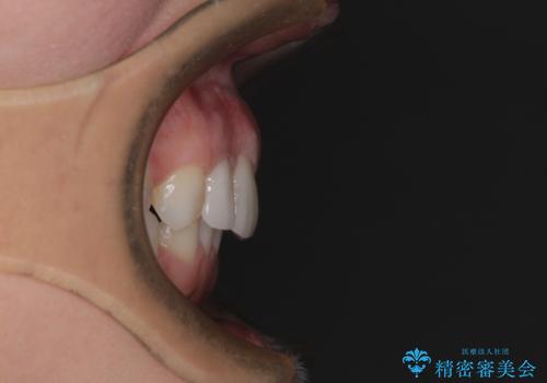 【モニター】前歯の変色とデコボコを改善 インビザラインとオールセラミックの治療後