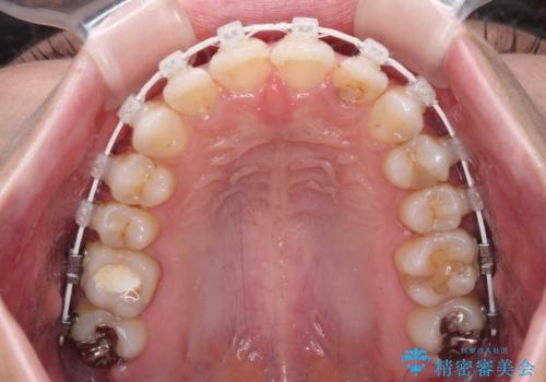 歯をきれいにしたい ワイヤー矯正治療と虫歯治療の治療中