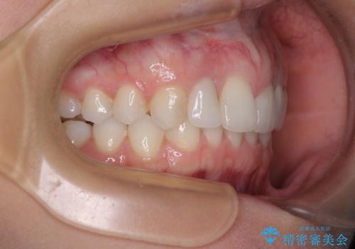 【モニター】前歯の変色とデコボコを改善 インビザラインとオールセラミックの治療後