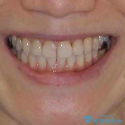 前歯の突出感と上下の隙間　インビザラインによる矯正治療の治療後（顔貌）