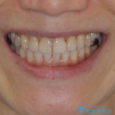 前歯の突出感と上下の隙間 インビザラインによる矯正治療の治療後(顔貌)