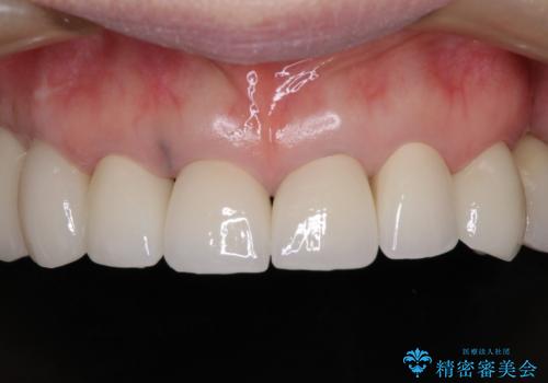 以前治療した歯がボロボロに 全顎補綴治療の治療後