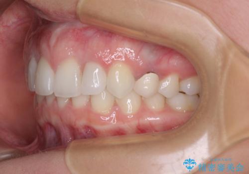 【モニター】前歯の変色とデコボコを改善 インビザラインとオールセラミックの治療後