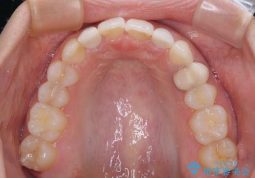 【モニター】前歯の変色とデコボコを改善 インビザラインとオールセラミックの治療後