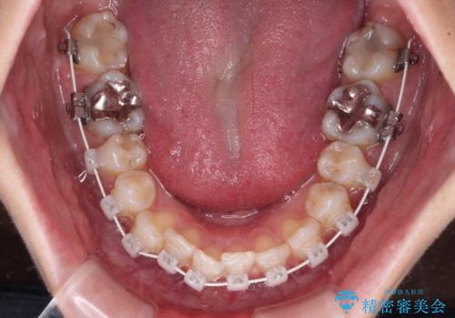 歯をきれいにしたい ワイヤー矯正治療と虫歯治療の治療中