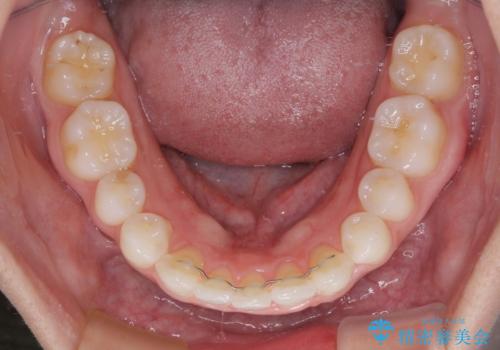 【モニター】前歯の変色とデコボコを改善 インビザラインとオールセラミックの治療後