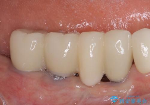 以前治療した歯がボロボロに　全顎補綴治療の治療後