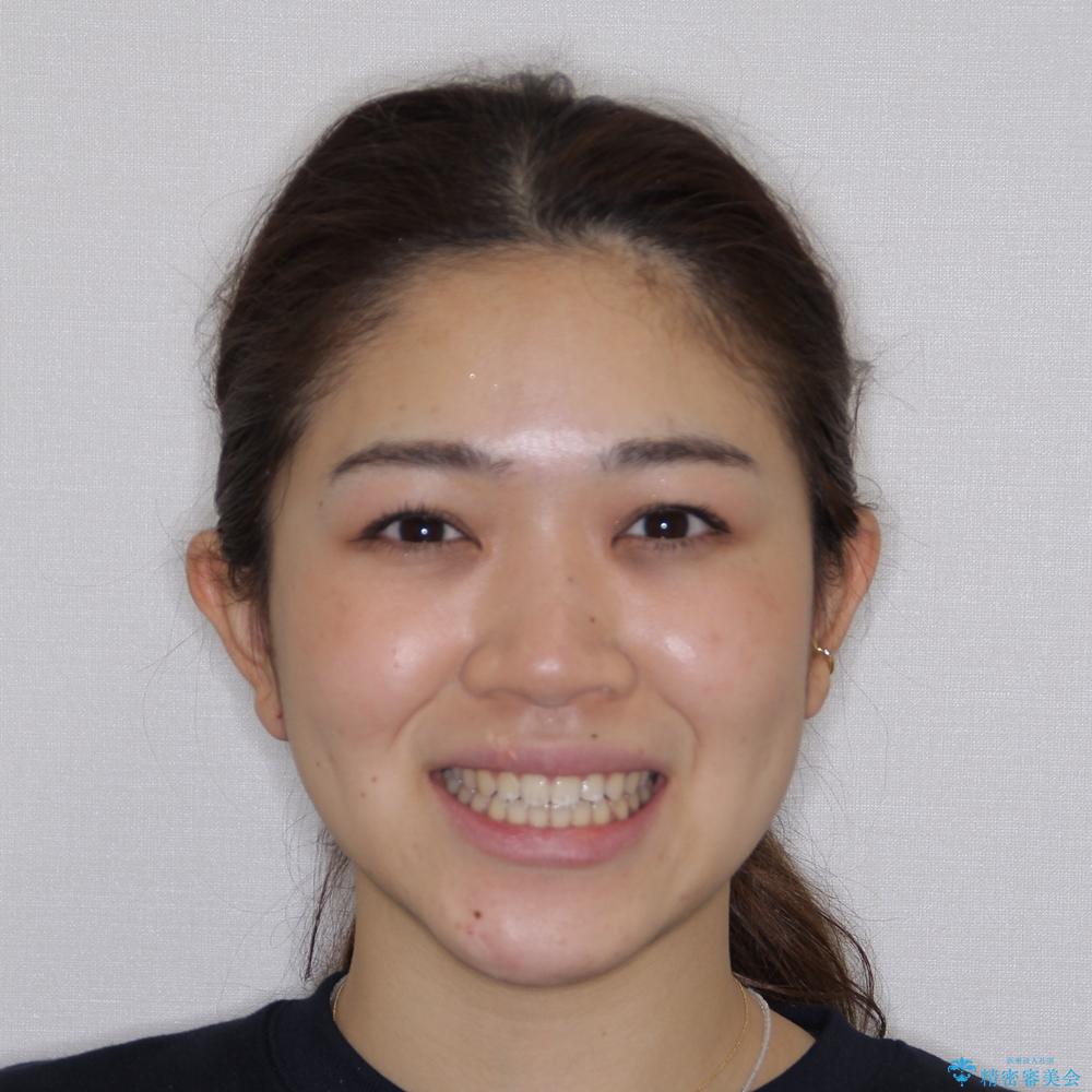 【モニター】隙間だらけの前歯を治したい インビザラインによる矯正治療の治療後(顔貌)