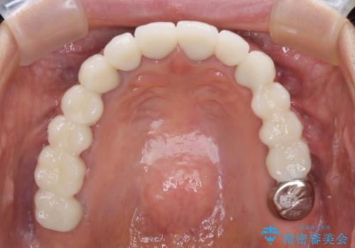 以前治療した歯がボロボロに 全顎補綴治療の治療後