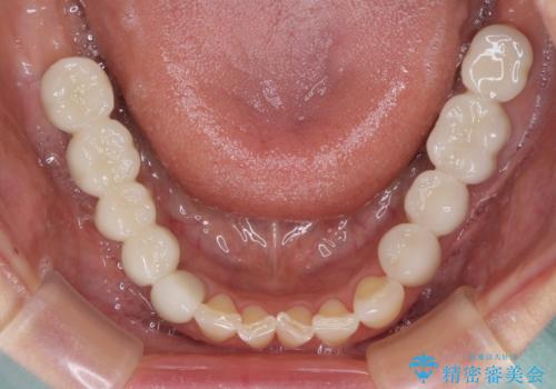 以前治療した歯がボロボロに 全顎補綴治療の治療後