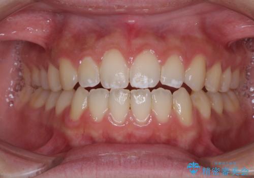 【モニター】隙間だらけの前歯を治したい インビザラインによる矯正治療の症例 治療後