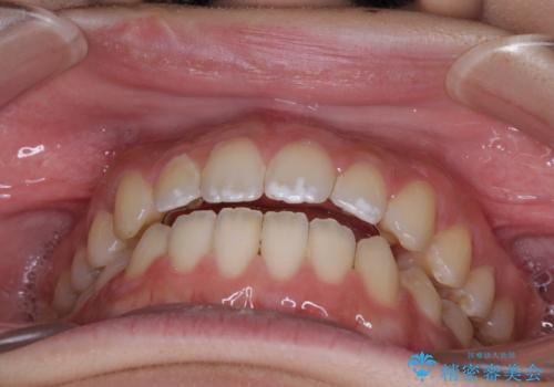 【モニター】隙間だらけの前歯を治したい インビザラインによる矯正治療の治療後