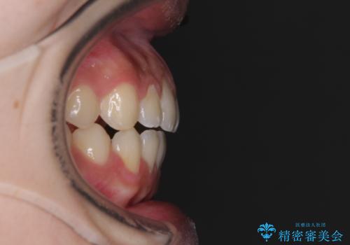 【モニター】隙間だらけの前歯を治したい インビザラインによる矯正治療の治療後