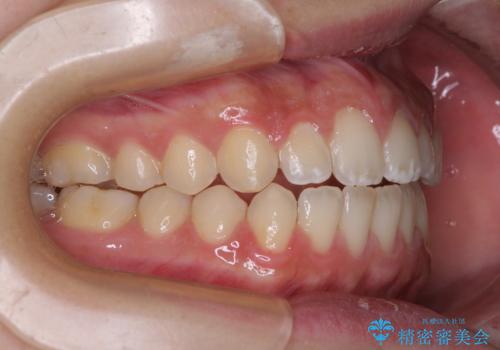 【モニター】隙間だらけの前歯を治したい インビザラインによる矯正治療の治療後