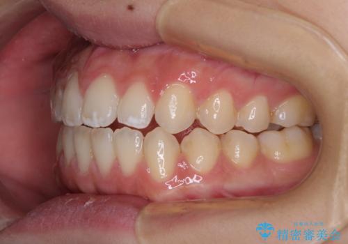 【モニター】隙間だらけの前歯を治したい インビザラインによる矯正治療の治療後