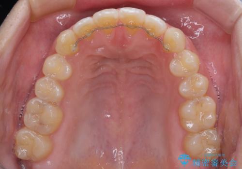 【モニター】隙間だらけの前歯を治したい インビザラインによる矯正治療の治療後