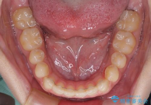 【モニター】隙間だらけの前歯を治したい インビザラインによる矯正治療の治療後