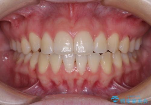 カリエール・ディスタライザーとインビザラインを用いた八重歯の改善の治療後