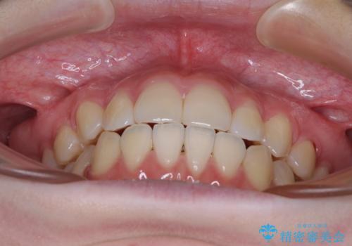 カリエール・ディスタライザーとインビザラインを用いた八重歯の改善の治療後