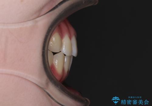 カリエール・ディスタライザーとインビザラインを用いた八重歯の改善の治療後