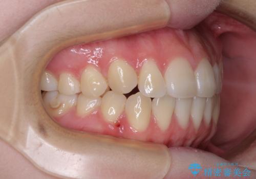 カリエール・ディスタライザーとインビザラインを用いた八重歯の改善の治療後