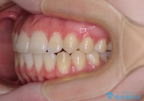 カリエール・ディスタライザーとインビザラインを用いた八重歯の改善の治療後