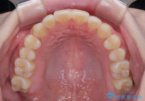 カリエール・ディスタライザーとインビザラインを用いた八重歯の改善の治療後