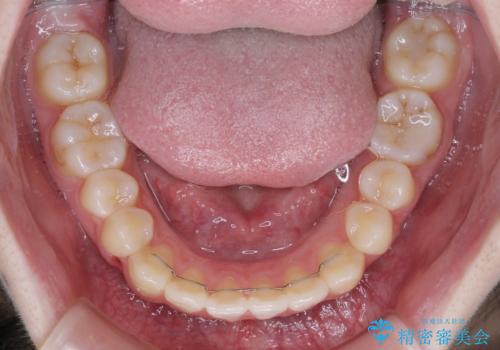 カリエール・ディスタライザーとインビザラインを用いた八重歯の改善の治療後