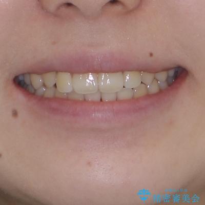 カリエール・ディスタライザーとインビザラインを用いた八重歯の改善の治療後（顔貌）