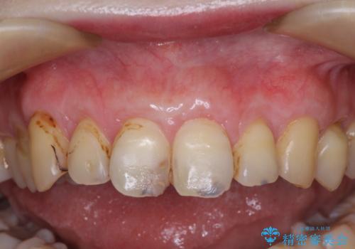 薄くて退縮しやすい前歯の歯肉　補綴治療前に歯肉移植で退縮しにくくの症例 治療後