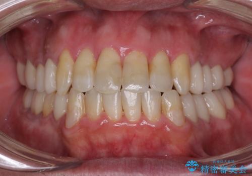 飛び出した前歯と目立つ銀歯 矯正とセラミックの総合歯科診療の症例 治療後