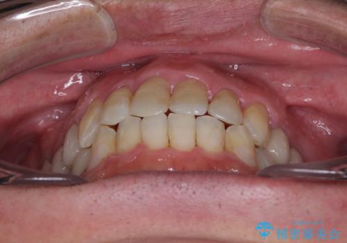飛び出した前歯と目立つ銀歯 矯正とセラミックの総合歯科診療の治療後