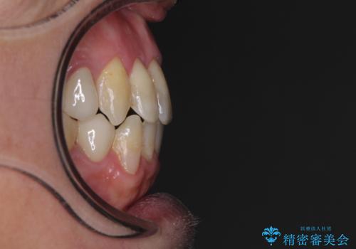 飛び出した前歯と目立つ銀歯 矯正とセラミックの総合歯科診療の治療後