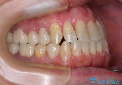 飛び出した前歯と目立つ銀歯 矯正とセラミックの総合歯科診療の治療後