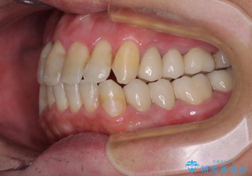 飛び出した前歯と目立つ銀歯 矯正とセラミックの総合歯科診療の治療後