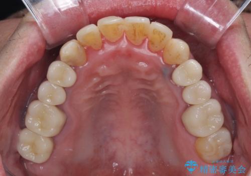 飛び出した前歯と目立つ銀歯 矯正とセラミックの総合歯科診療の治療後