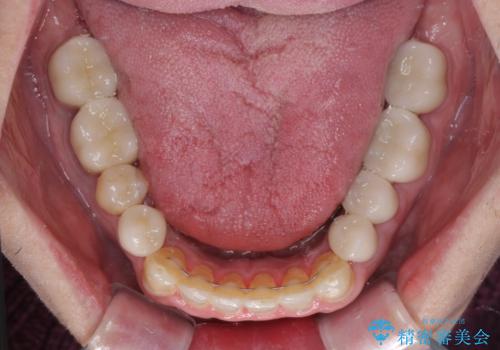 飛び出した前歯と目立つ銀歯 矯正とセラミックの総合歯科診療の治療後