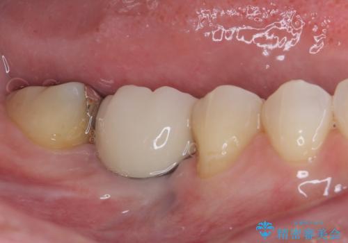 歯が全く咬みあわない 矯正と補綴の全顎治療の治療後