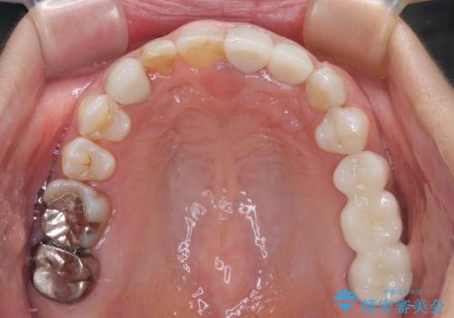 歯が全く咬みあわない 矯正と補綴の全顎治療の治療後