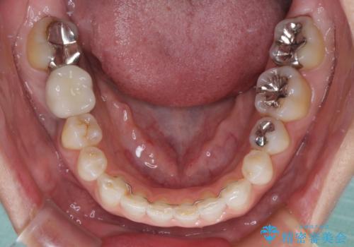 歯が全く咬みあわない 矯正と補綴の全顎治療の治療後