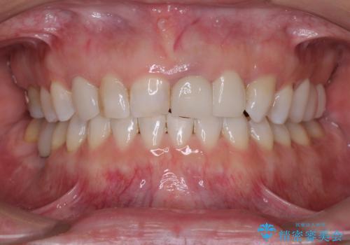 歯が全く咬みあわない　矯正と補綴の全顎治療の治療後