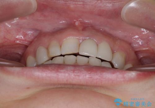 歯が全く咬みあわない 矯正と補綴の全顎治療の治療後