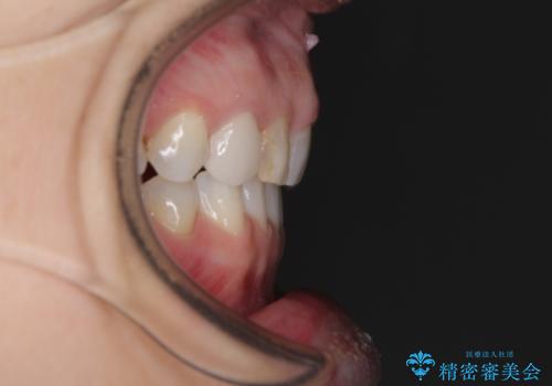 歯が全く咬みあわない 矯正と補綴の全顎治療の治療後