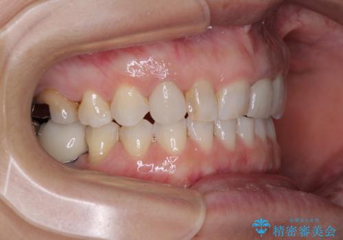 歯が全く咬みあわない 矯正と補綴の全顎治療の治療後