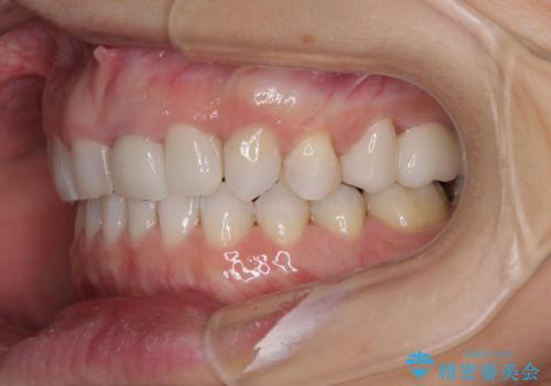 歯が全く咬みあわない　矯正と補綴の全顎治療の治療後