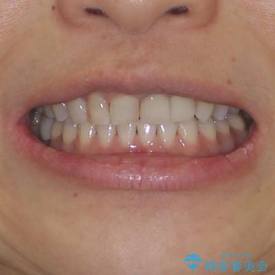 歯が全く咬みあわない　矯正と補綴の全顎治療の治療後（顔貌）