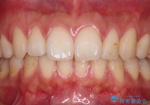 鼻の下を押すと痛い 前歯の根管治療とオールセラミッククラウンの治療前